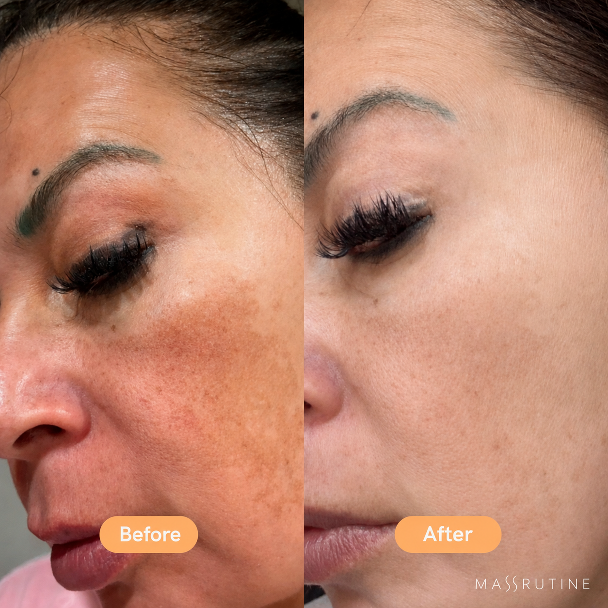 Massrutine Facial Mask - LED Facial Mask